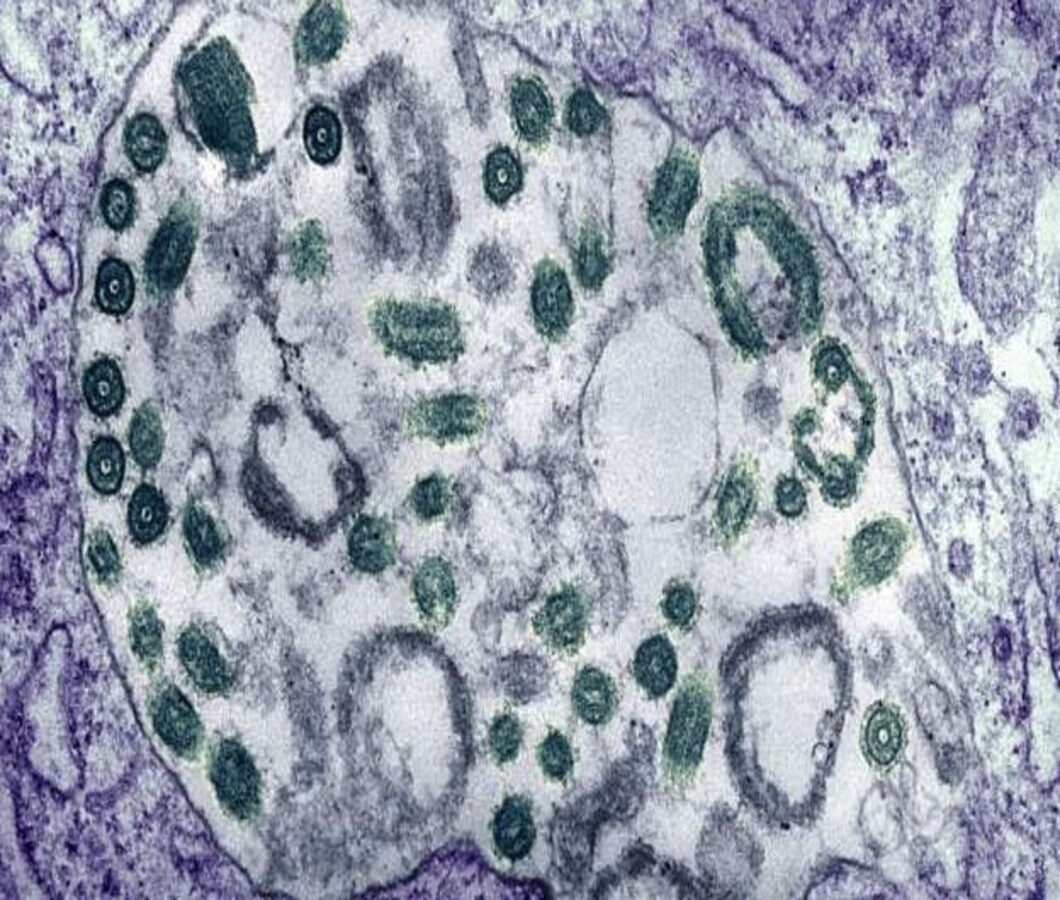 Read more about the article Ghana reports two suspected Marburg virus cases